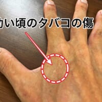 歩きタバコによる火傷の傷