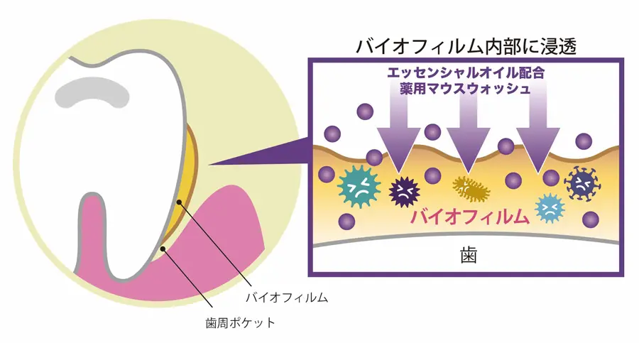 歯磨きやフロスに加えてマウスウォッシュの併用がおすすめ